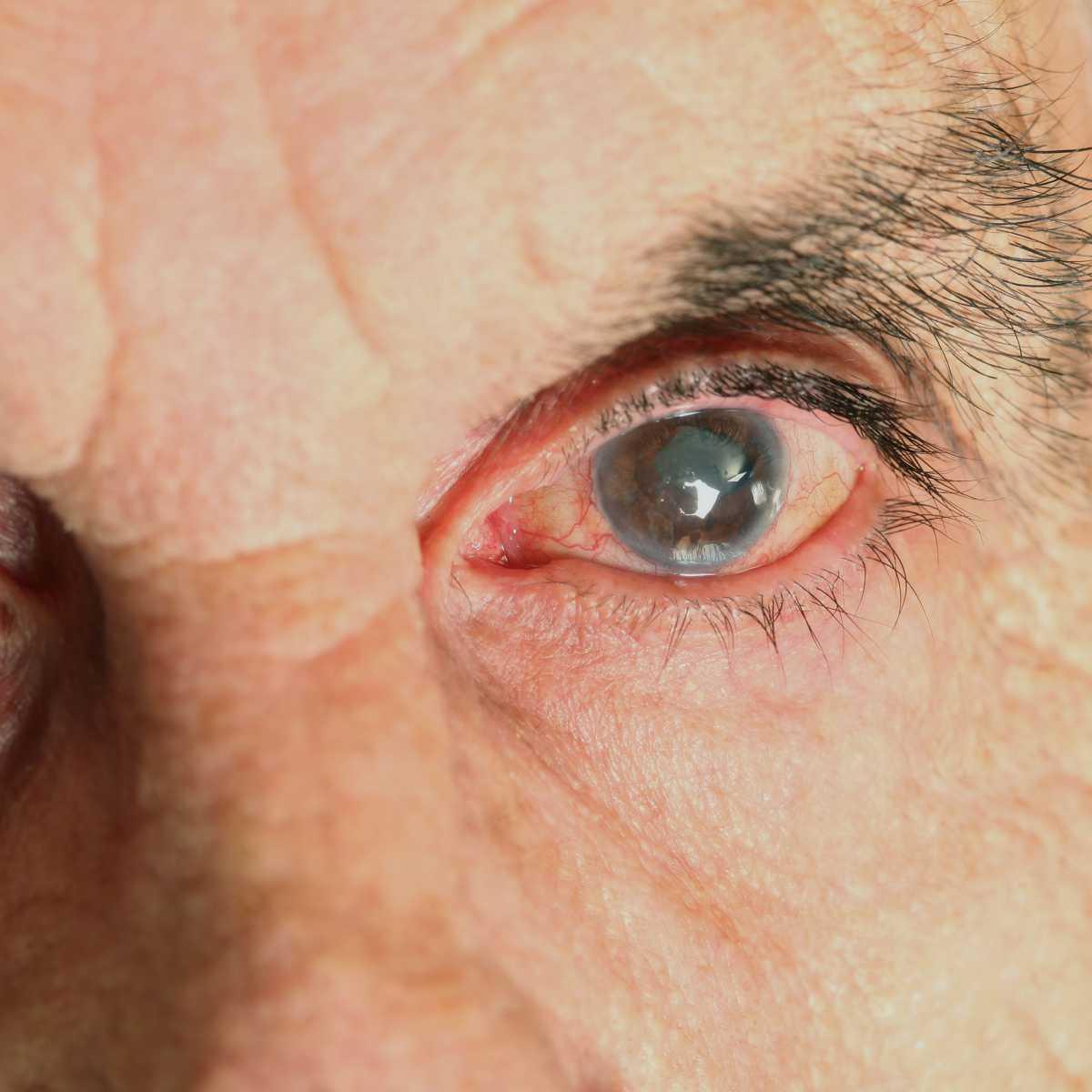 Glaucoma