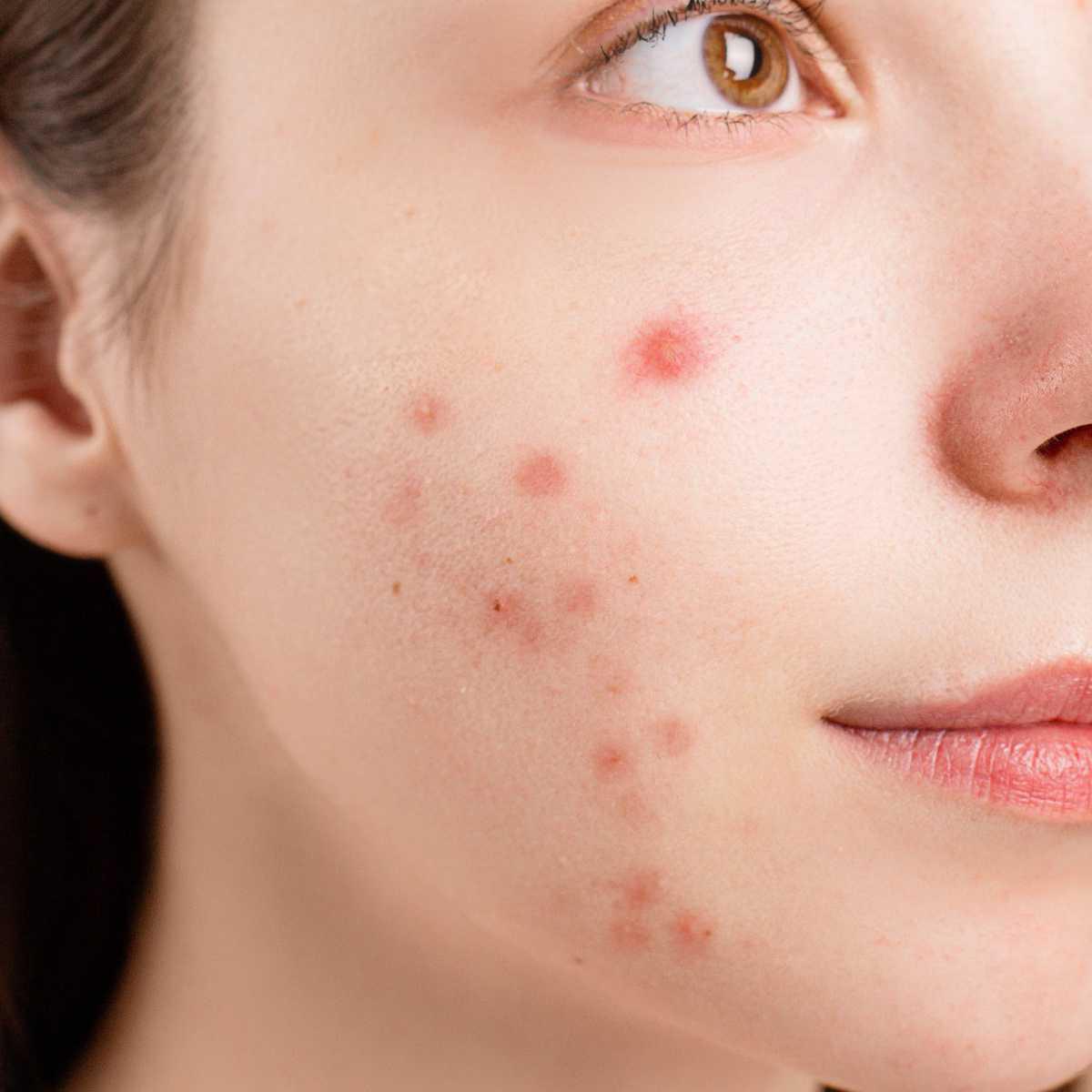 Loção anti-acne