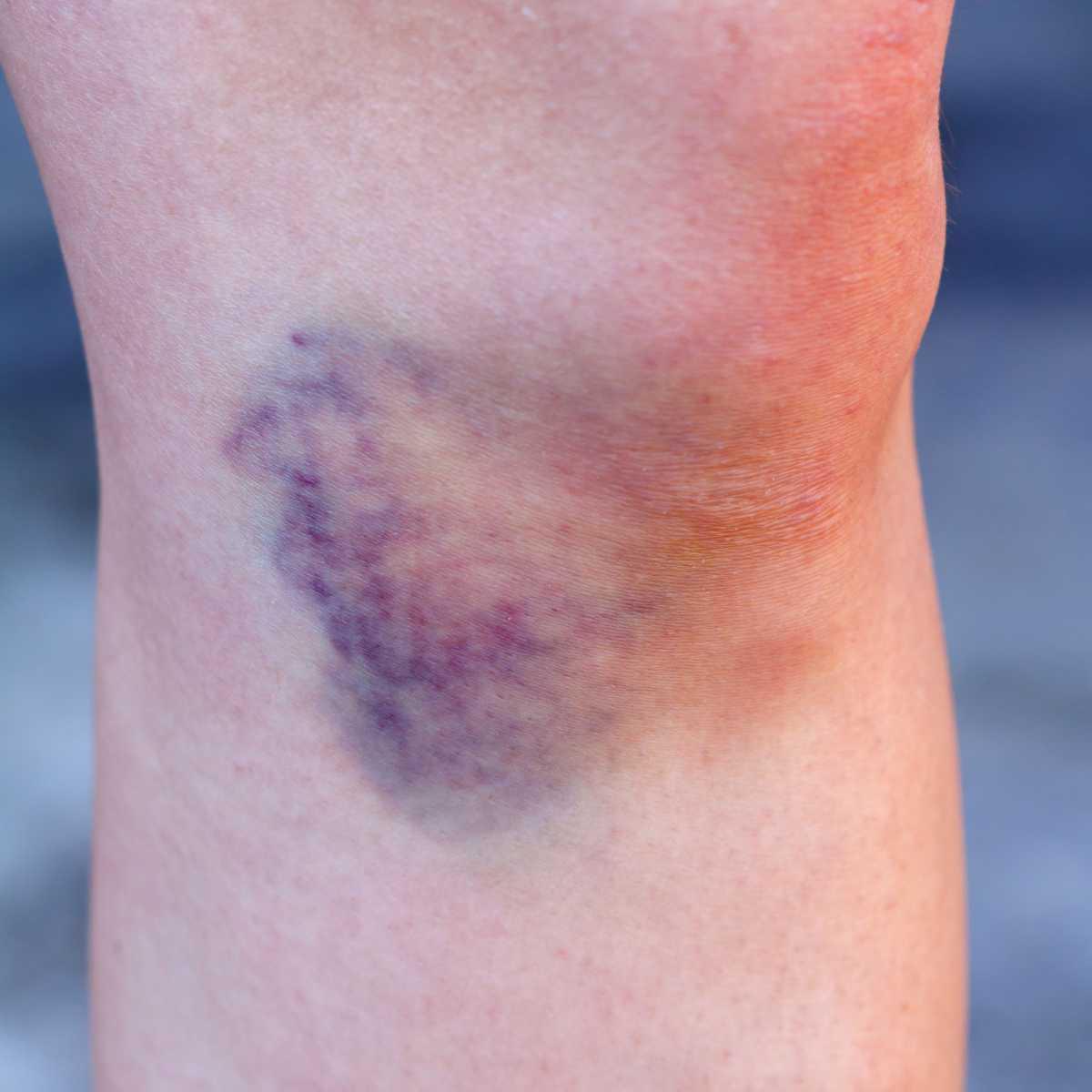 Óleo anti-hematoma