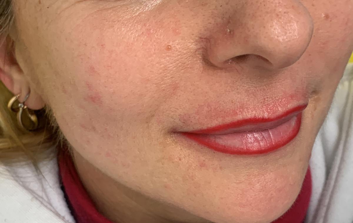 Dermopigmentazione Dermopigmentazione