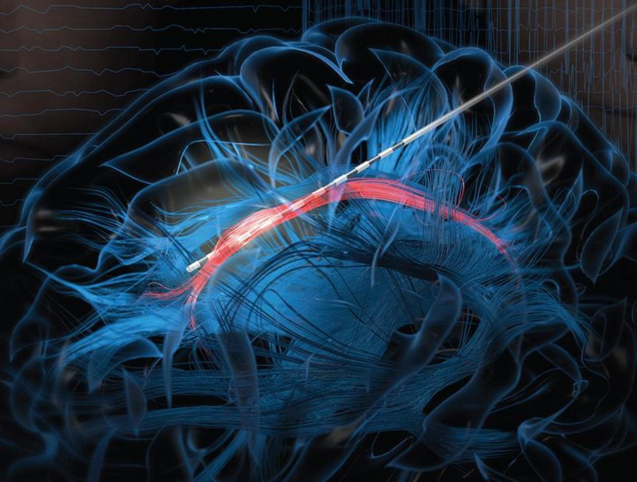 La ilustración muestra cómo se utilizó un electrodo para estimular el haz de cingulum. Imagen: American Society of Clinical Investigation / University of Emory.