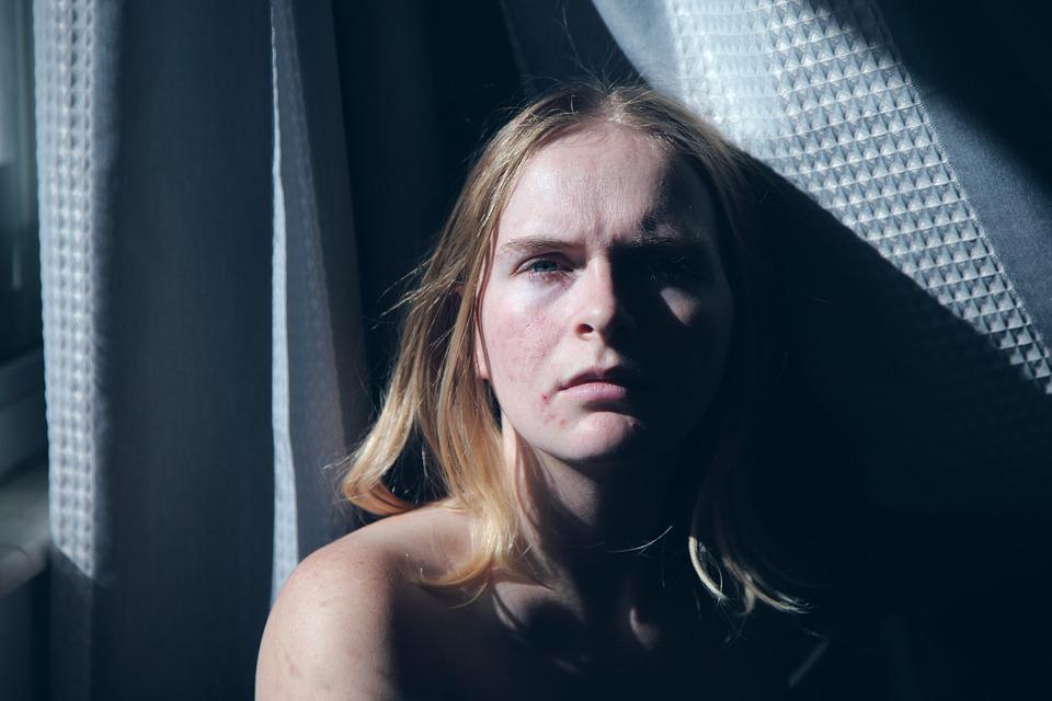 El acné es más común en la adolescencia. Imagen: Sharon McCutcheon.
