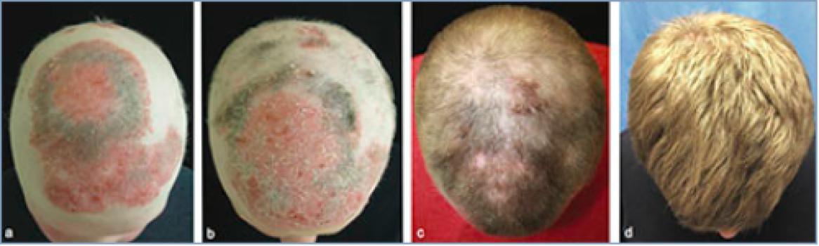A) Cabeza del paciente antes del tratamiento con tofacitinib. B) Dos meses después de iniciado el tratamiento. C) Cinco meses después del tratamiento, y D) Ocho meses después de iniciado el tratamiento. Fuente: Universidad de Yale.
