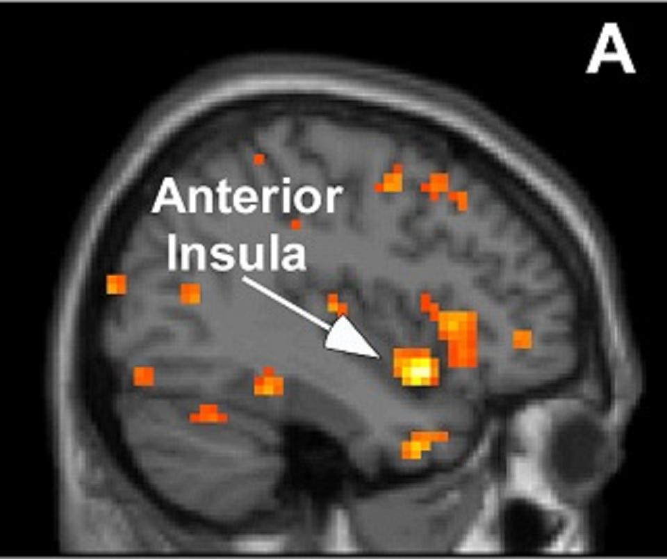 Composición comparativa de los cerebros de personas altamente sensibles (HSP) con individuos no-HSP. Las áreas de color representan algunas de las regiones del cerebro donde se produce una mayor activación en individuos HSP, en comparación con el resto. La región del cerebro altamente asociada con la empatía y la captación de emociones (la ínsula) mostró una activación significativamente mayor en las HSP cuando estas vieron una foto de su pareja sonriendo. Fuente: Universidad Stony Brook.