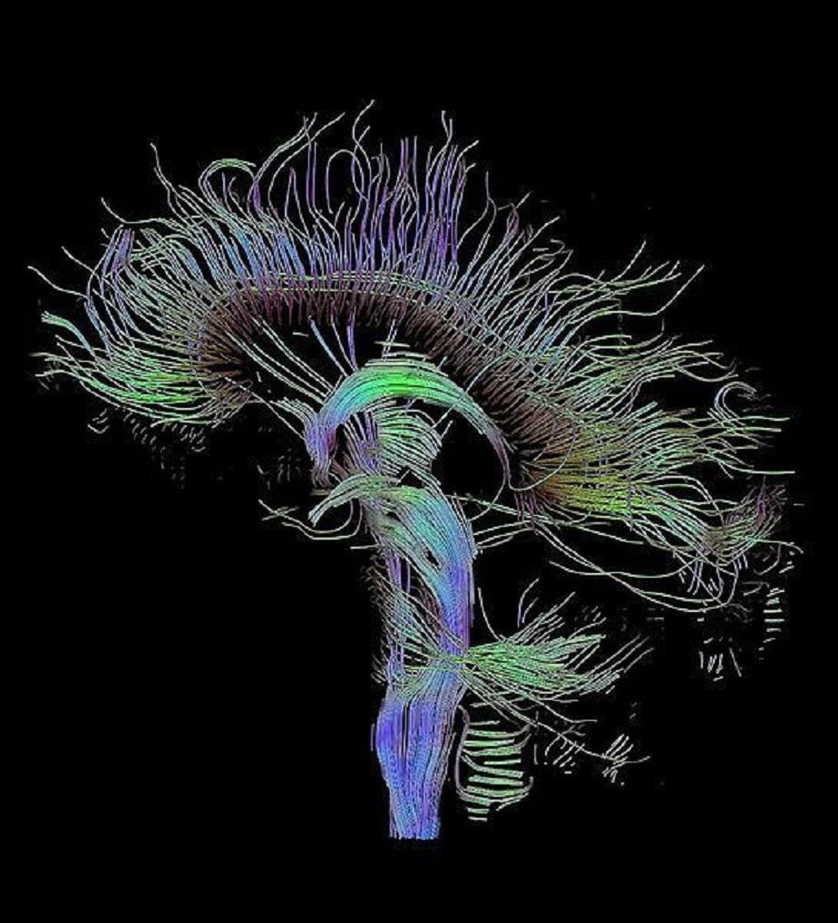 Reconstrucción tractográfica de las conexiones neurales a través de imagen por resonancia magnética. Fuente: Wikimedia Commons. 