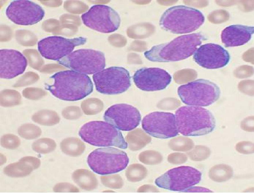 Médula ósea de paciente con leucemia. Imagen: VashiDonsk. Fuente: Wikipedia.