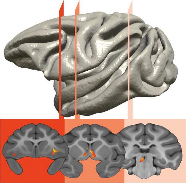 Un circuito cerebral que implica a tres regiones del cerebro es el responsable de la transferencia genética del temperamento ansioso. Fuente: Kalin Lab/Universidad de Wisconsin-Madison.
