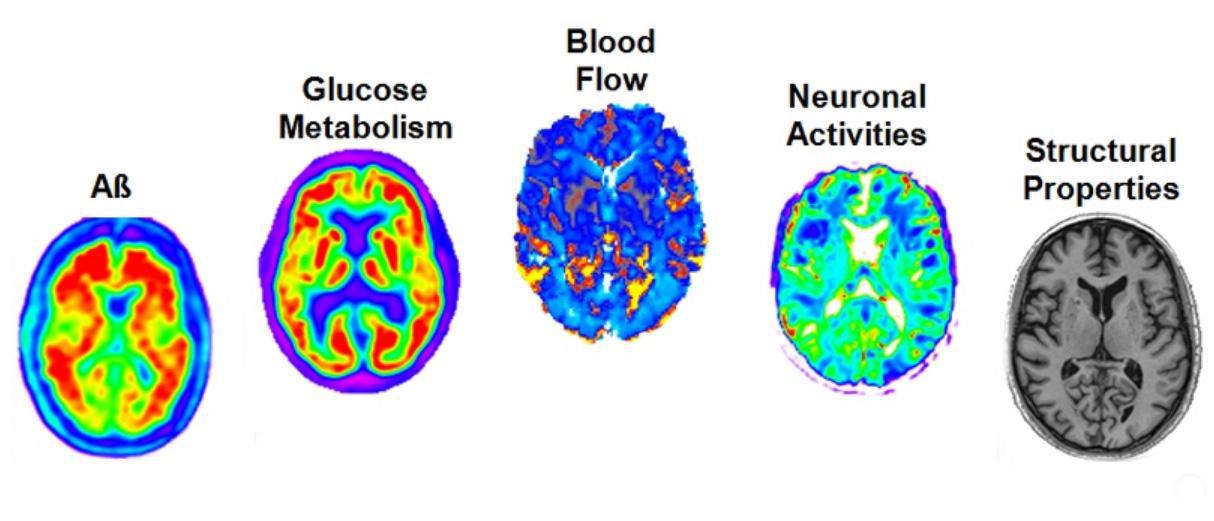 El estudio utiliza la Resonancia Magnética y la PET para estudiar las imágenes cerebrales. Fuente: McGill