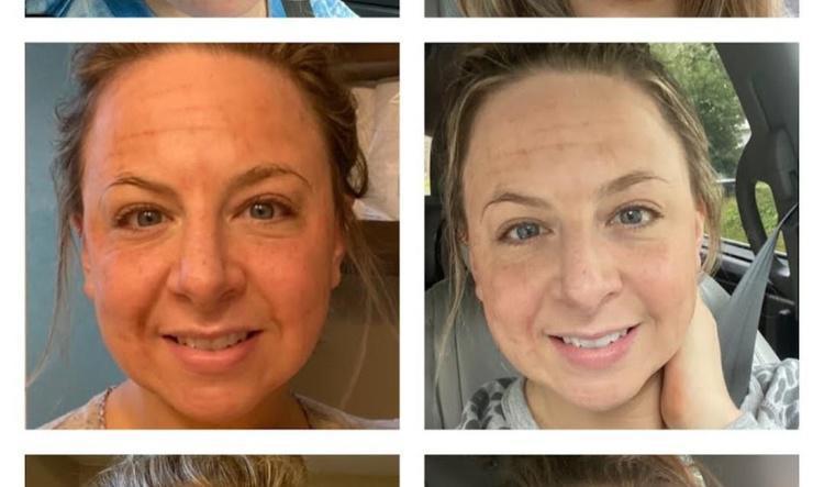 Unveiling Your Inner Radiance: The Transformative Power of Nano Laser Peel