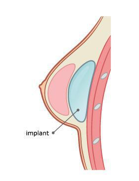 La reconstruction La reconstruction