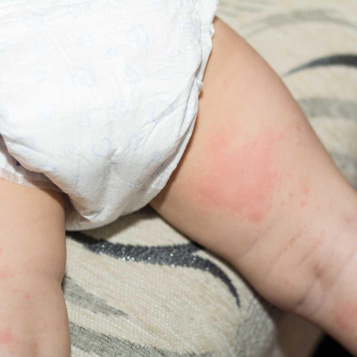 Diaper rash