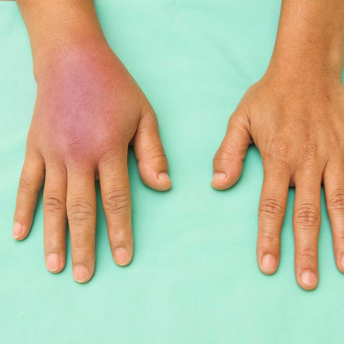 Swollen Joints