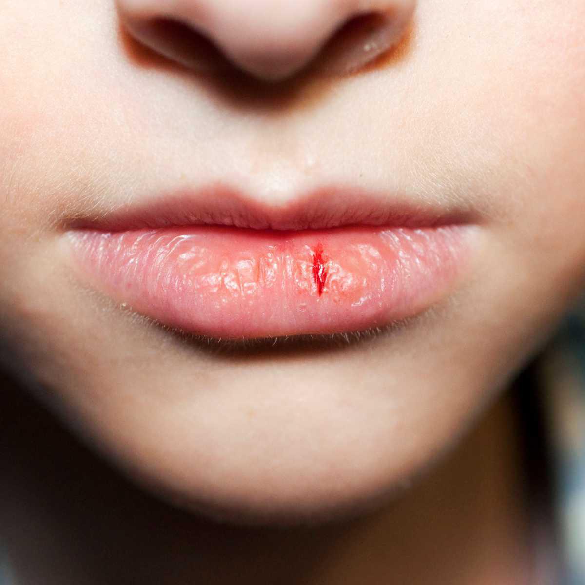 Chapped lips (Cheilitis)