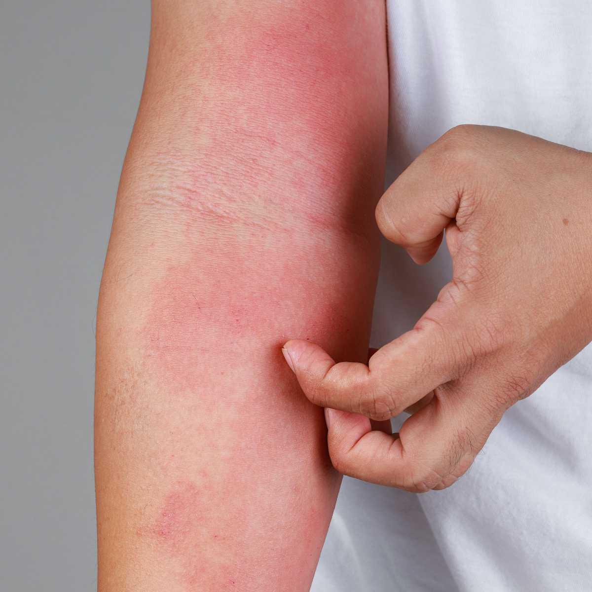 Skin redness