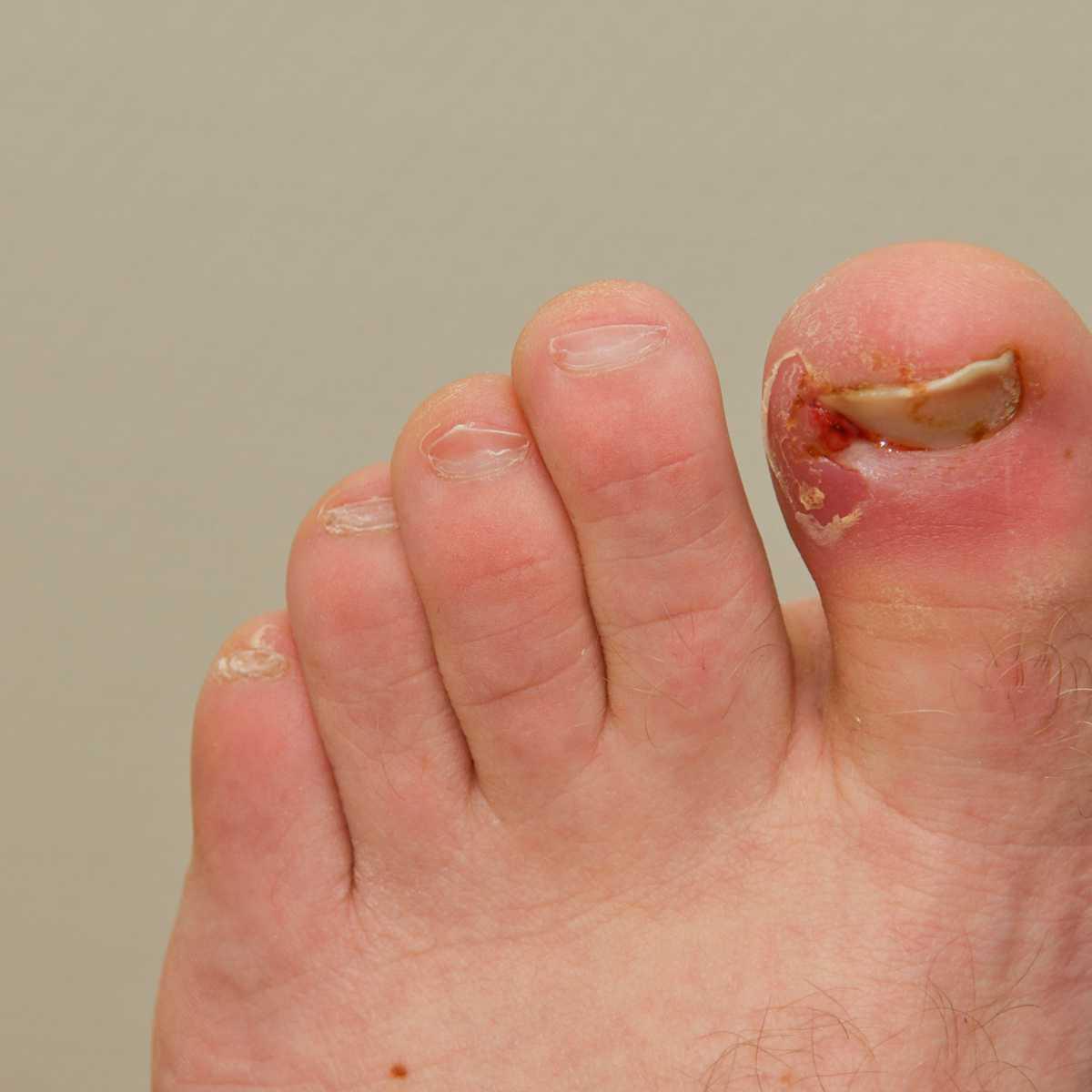 Ingrown toenail