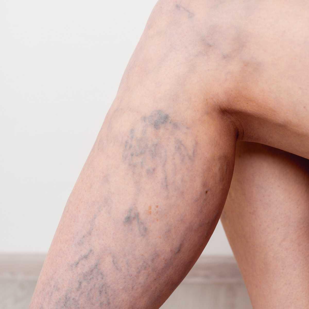 Varicose veins