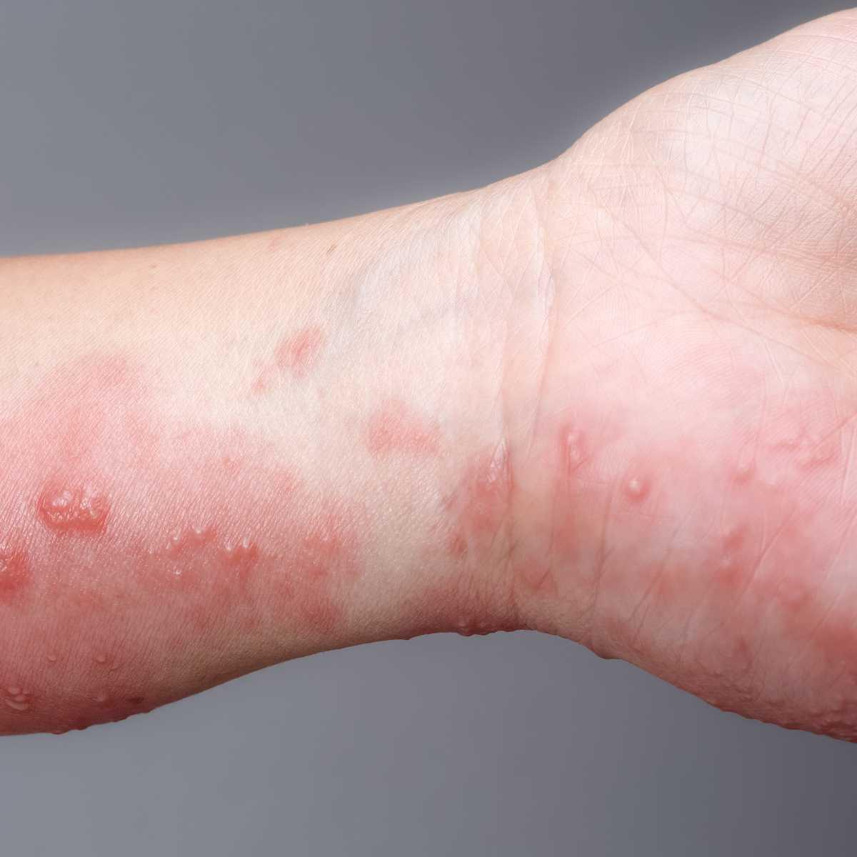 Scabies 