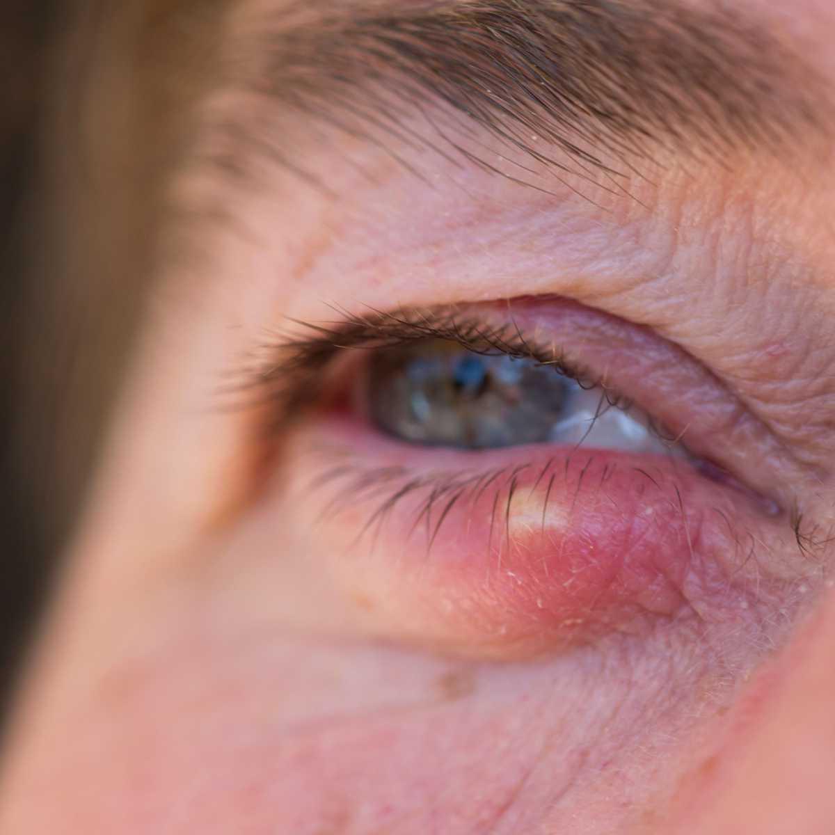 Stye (sty)