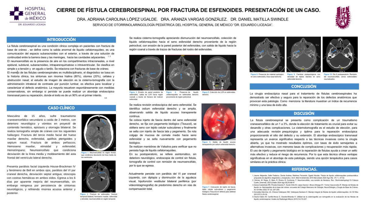 CNUM 2- CIERRE DE FÍSTULA CEREBROESPINAL POR FRACTURA DE ESFENOIDES. PRESENTACIÓN DE UN CASO