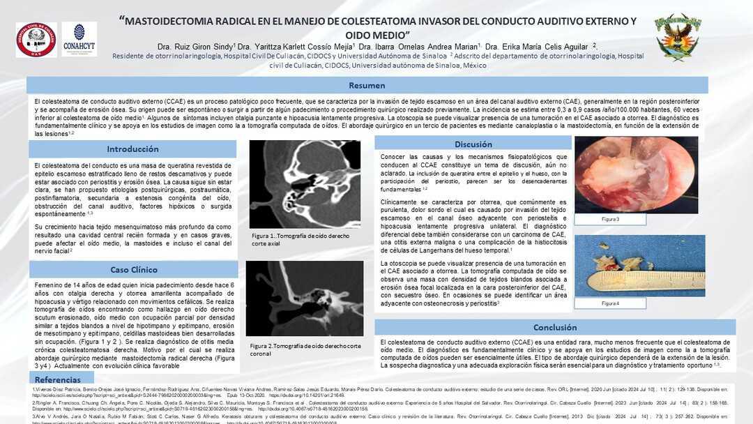 CNUM 5 - MASTOIDECTOMIA RADICAL EN EL MANEJO DE COLESTEATOMA INVASOR DEL CONDUCTO AUDITIVO EXTERNO Y OIDO MEDIO