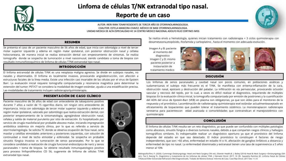 CNUM 12 - LINFOMA DE CÉLULAS T/NK EXTRANODAL TIPO NASAL. REPORTE DE UN CASO