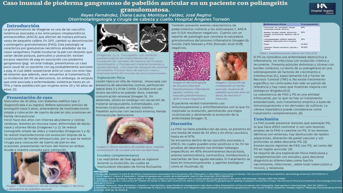 CNUM 15 - CASO INUSUAL DE PIODERMA GANGRENOSO DE PABELLÓN AURICULAR EN UN PACIENTE CON POLIANGEITIS GRANULOMATOSA.