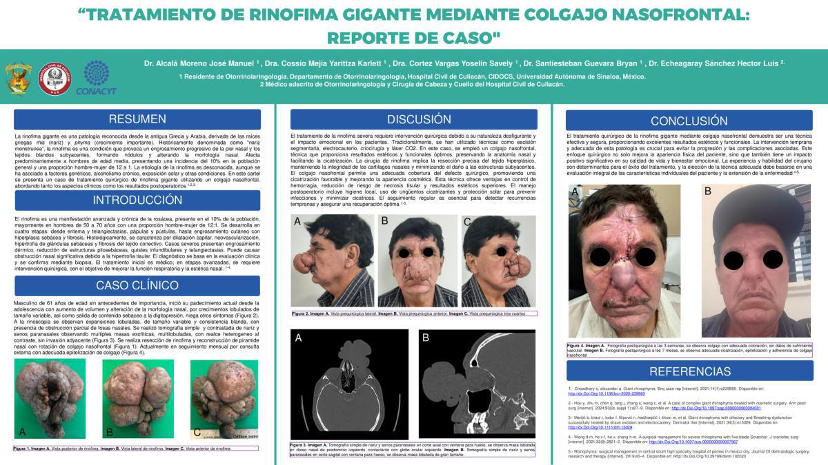 CNUM 18 - TRATAMIENTO DE RINOFIMA GIGANTE MEDIANTE COLGAJO NASOFRONTAL: REPORTE DE CASO