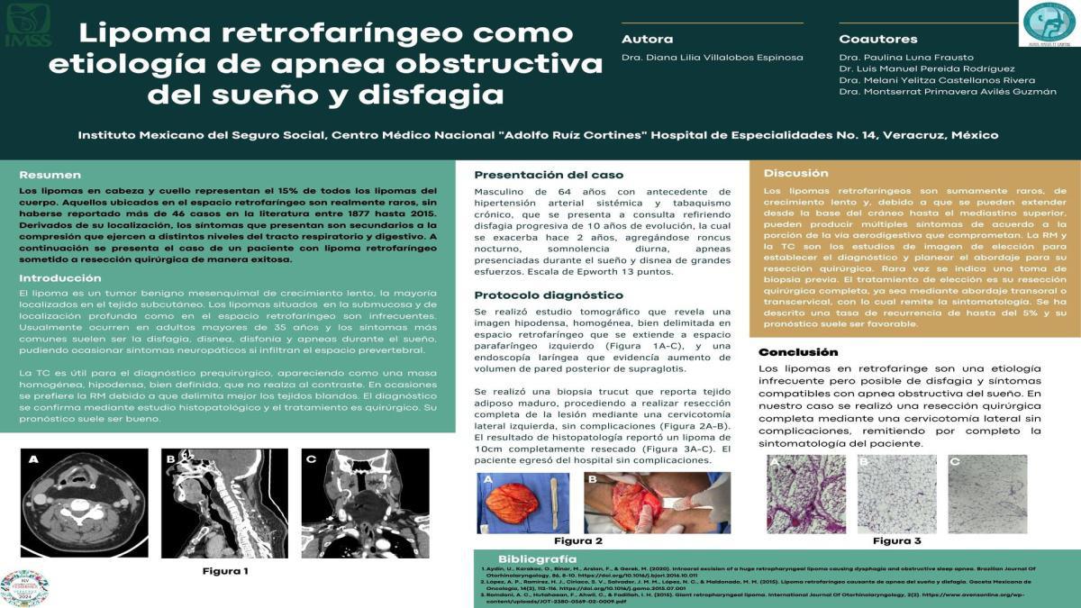 CNUM 20 - LIPOMA RETROFARÍNGEO COMO ETIOLOGÍA DE APNEA OBSTRUCTIVA DEL SUEÑO Y DISFAGIA