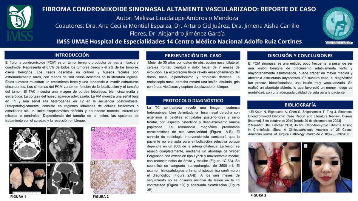 CNUM 22 - FIBROMA CONDROMIXOIDE SINONASAL ALTAMENTE VASCULARIZADO: REPORTE DE CASO