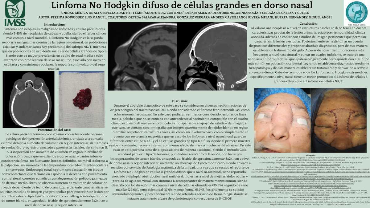 CNUM 26 - LINFOMA NO HODGKIN DIFUSO DE CÉLULAS GRANDES EN DORSO NASAL