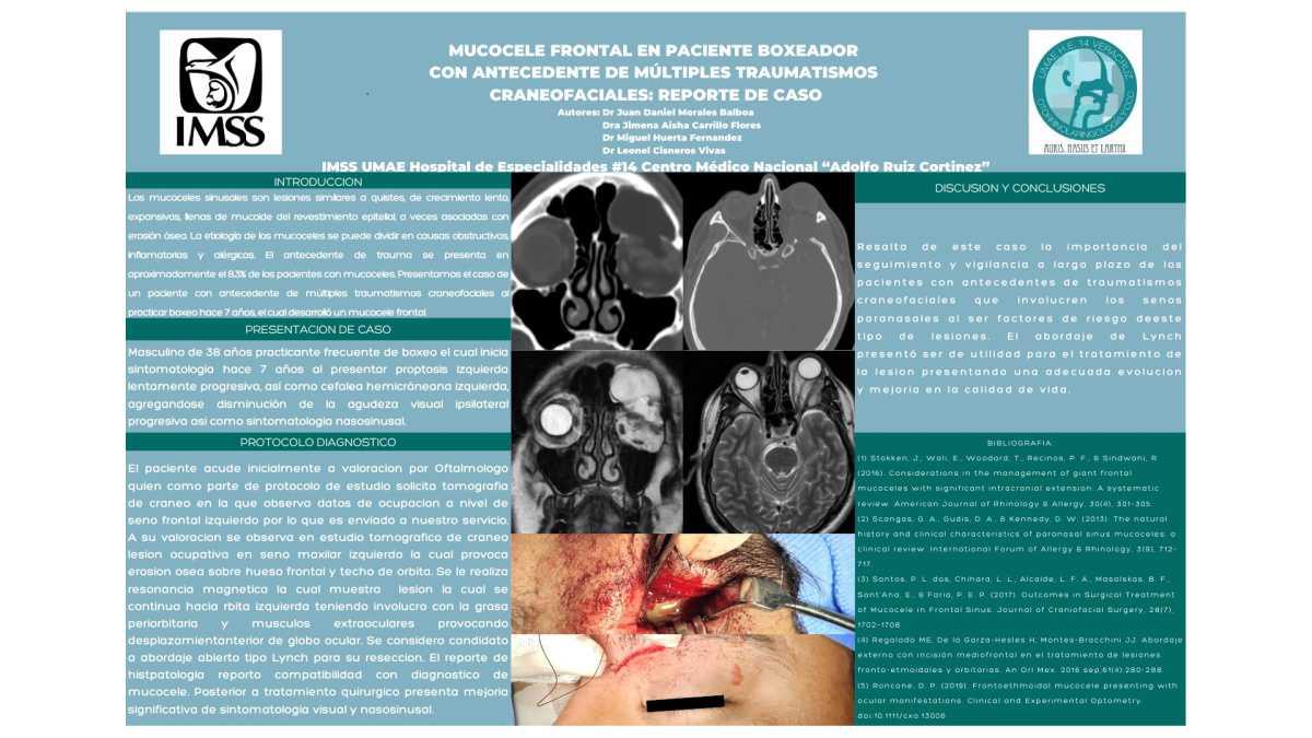 CNUM 28 - MUCOCELE FRONTAL EN PACIENTE CON ANTECEDENTE DE MÚLTIPLES TRAUMATISMOS CRANEOFACIALES: REPORTE DE CASO