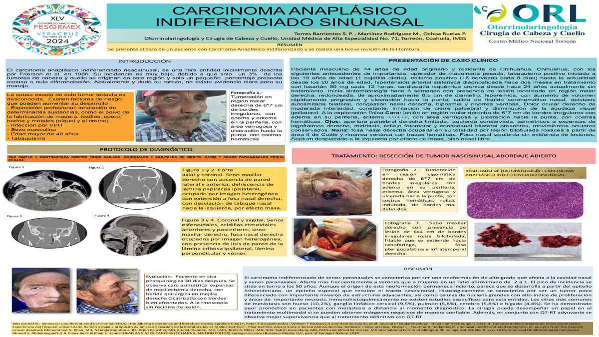 CNUM 35 - CARCINOMA ANAPLÁSICO INDIFERENCIADO NASOSINUSAL