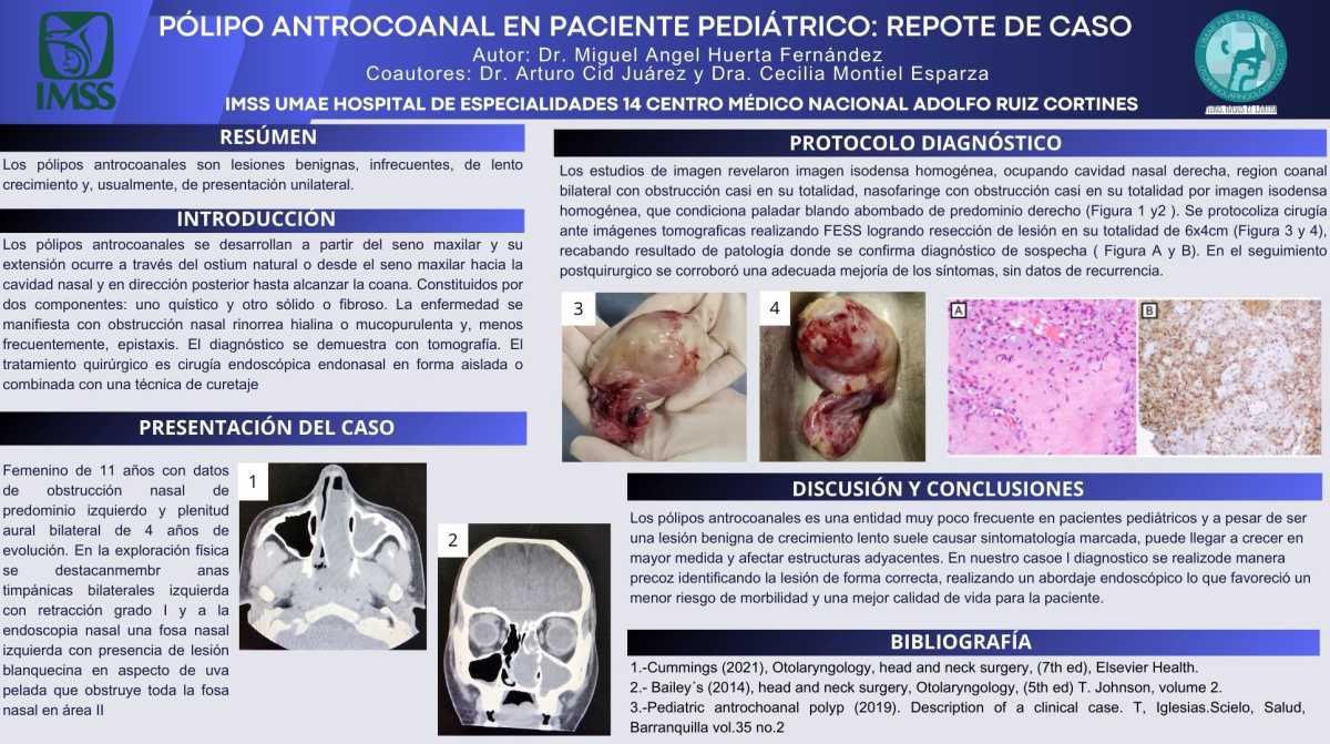 CNUM 38 - POLIPO ANTROCOANAL EN PACIENTE PEDIATRICO REPORTE DE CASO