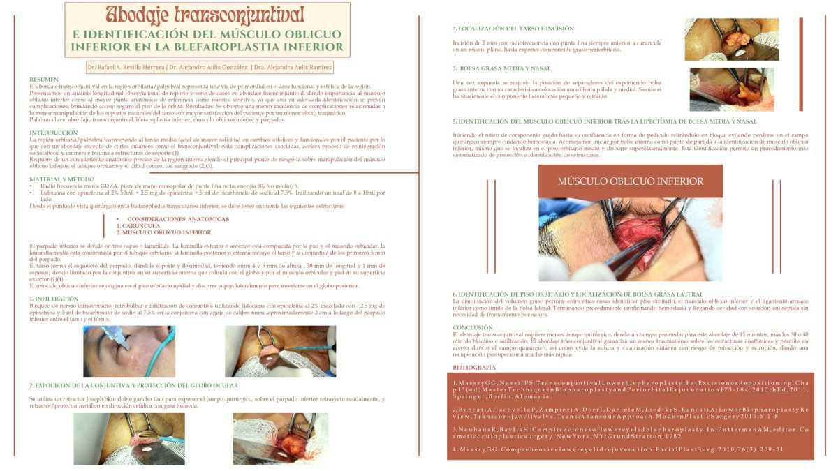 CNUM 43 - ABORDAJE TRANSCONJUNTIVAL E IDENTIFICACION DEL MUSCULO OBLICUO INFERIRO EN LA BLEFAROPLASTIA INFERIOROR.