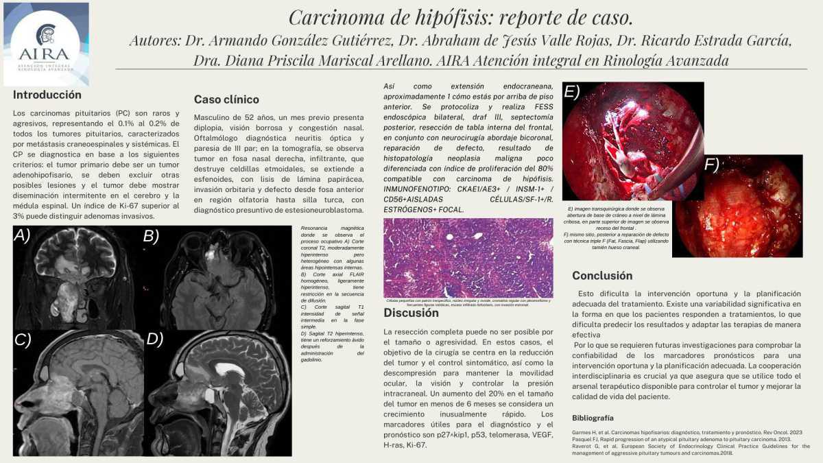 CNUM 44 - CARCINOMA DE HIPÓFISIS: REPORTE DE CASO