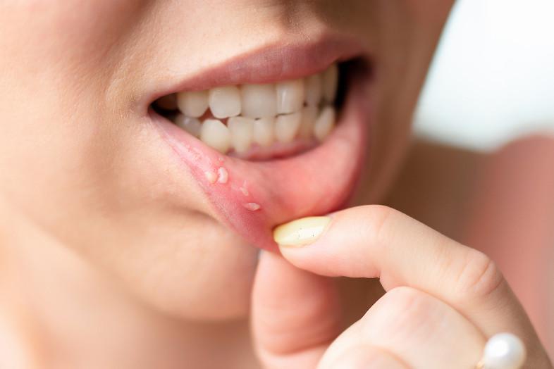 Estate, il caldo e... LE AFTE!