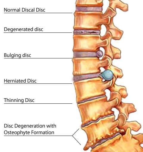 Low Back Pain
