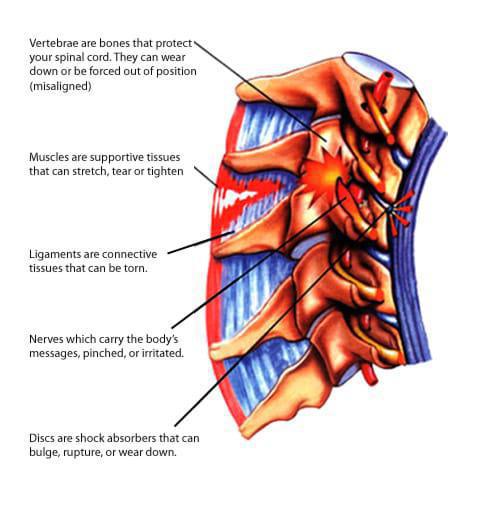 Neck Pain