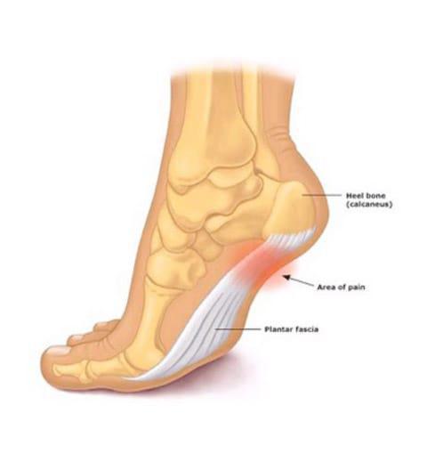 Plantar Fascitis Plantar Fascitis