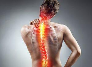 Scoliosis Scoliosis