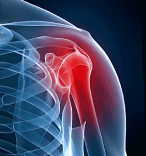 Shoulder, Arm, Hand, and Neck Pain