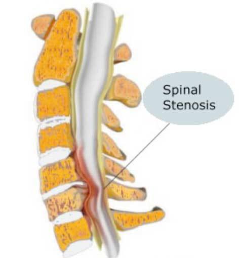 Spinal Stenosis Spinal Stenosis