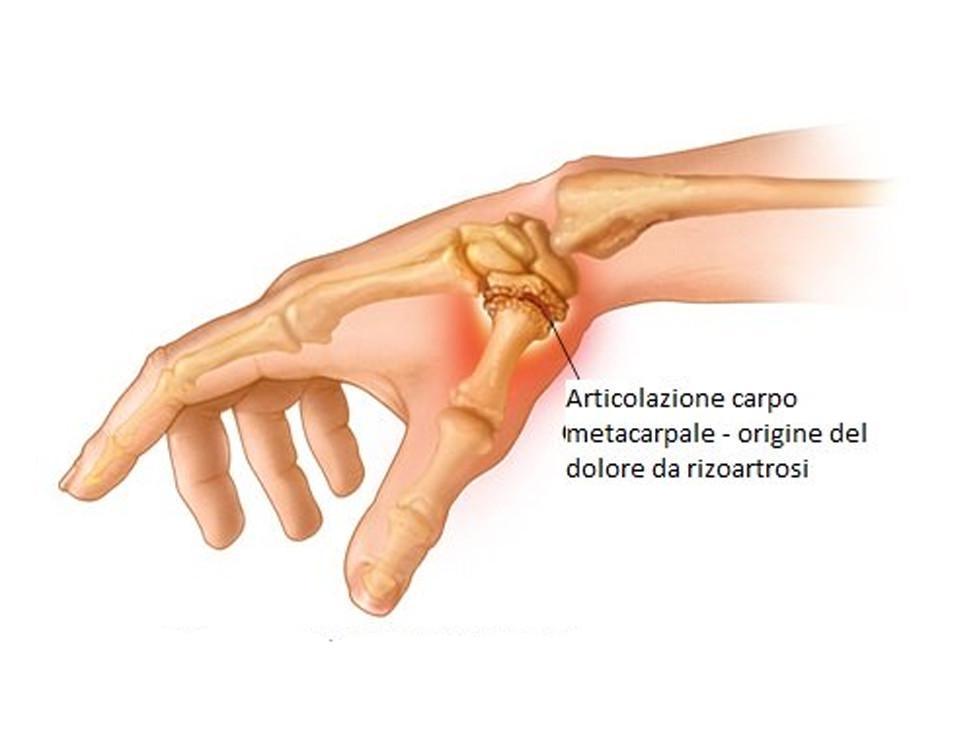 4 | La riabilitazione della mano in un paziente con Rizoartrosi