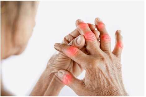 Osteoartrosi della mano Osteoartrosi della mano