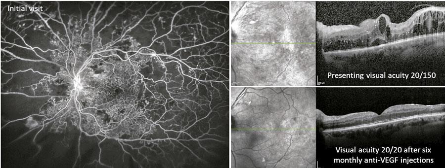 Tratamiento de la retinopatía diabética proliferativa