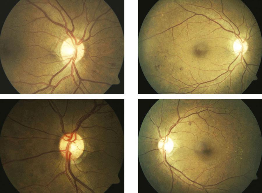 Tratamiento de la retinopatía diabética proliferativa