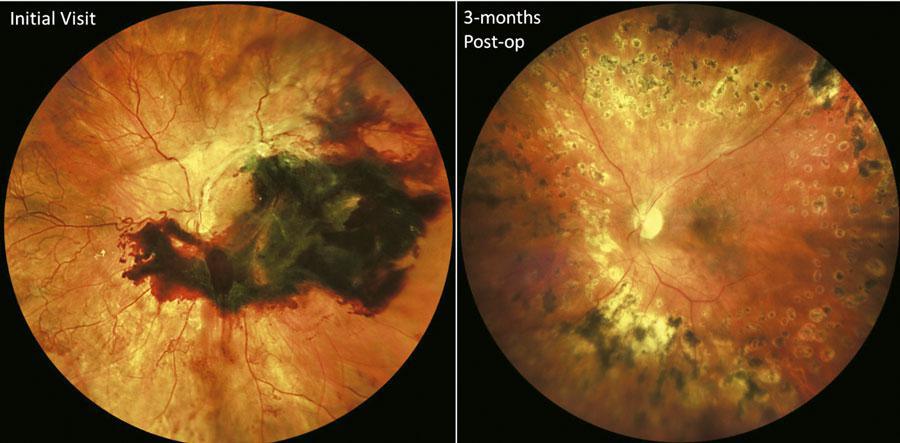 Tratamiento de la retinopatía diabética proliferativa