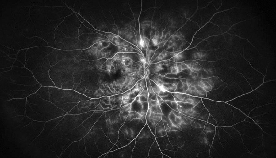 Tratamiento de la retinopatía diabética proliferativa