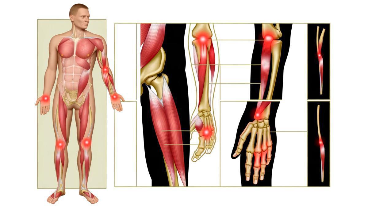 Revolutionizing Tendinitis Management: A New Dawn with Rife Therapy and Electroherbalism Revolutionizing Tendinitis Management: A New Dawn with Rife Therapy and Electroherbalism