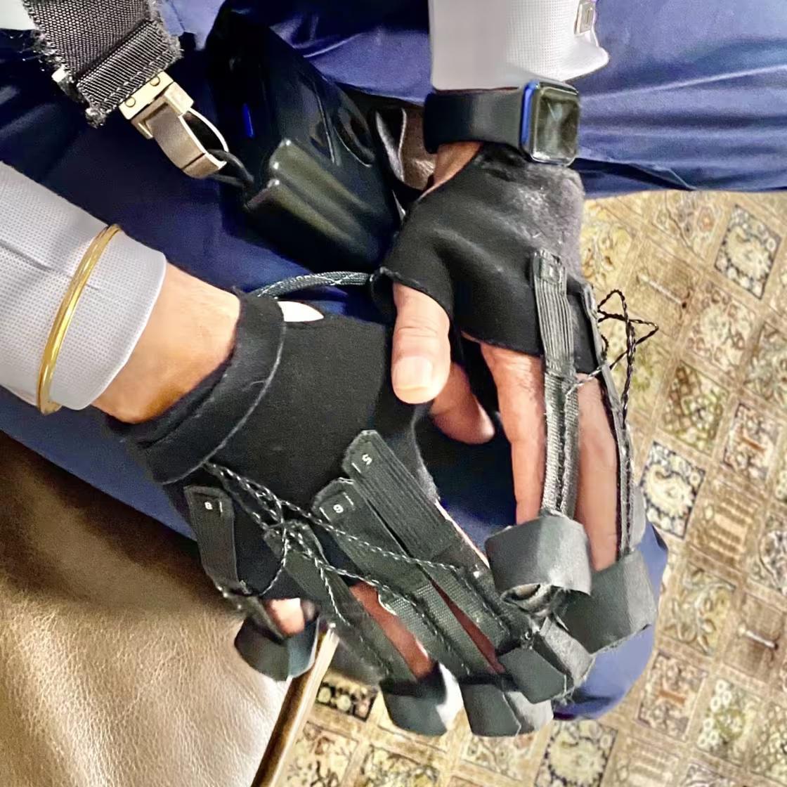 Experimental Glove Treatment Transforms Life for Parkinson's Patient Experimental Glove Treatment Transforms Life for Parkinson's Patient